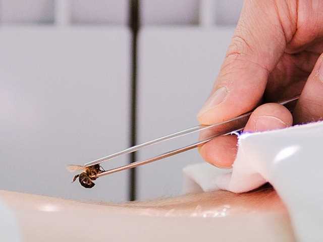 Arı terapisi ve Arı Sokmasının Kullanıldığı Alternatif Tedavi Yöntemi