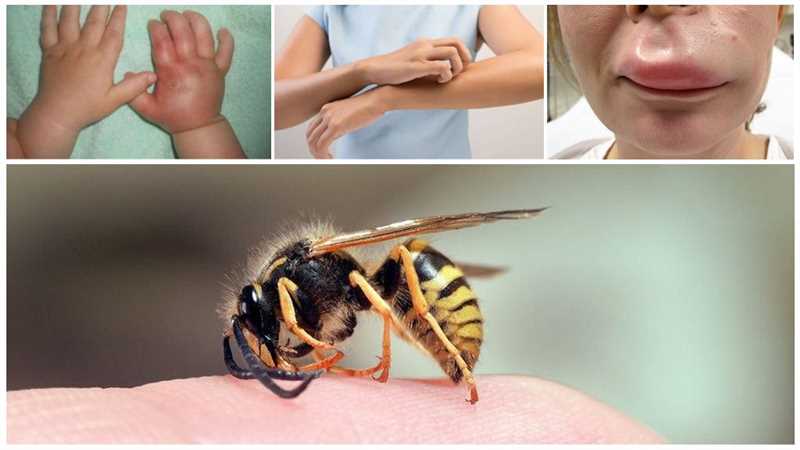 Evde şişlik nasıl tedavi edilir, evde arı ısırığı nasıl tedavi edilir?