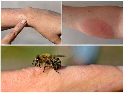 11. Pipi arı sokması alerjik reaksiyonu tedavisinde nelere dikkat etmek gerekir?